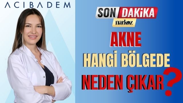 Akne Hangi Bölgede Neden Çıkar?